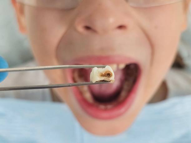 Best Emergency Broken Tooth Repair in Grantville, GA